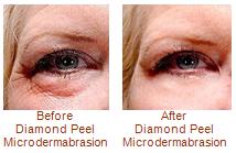 Diamond Peel Microdermabrasion Before After