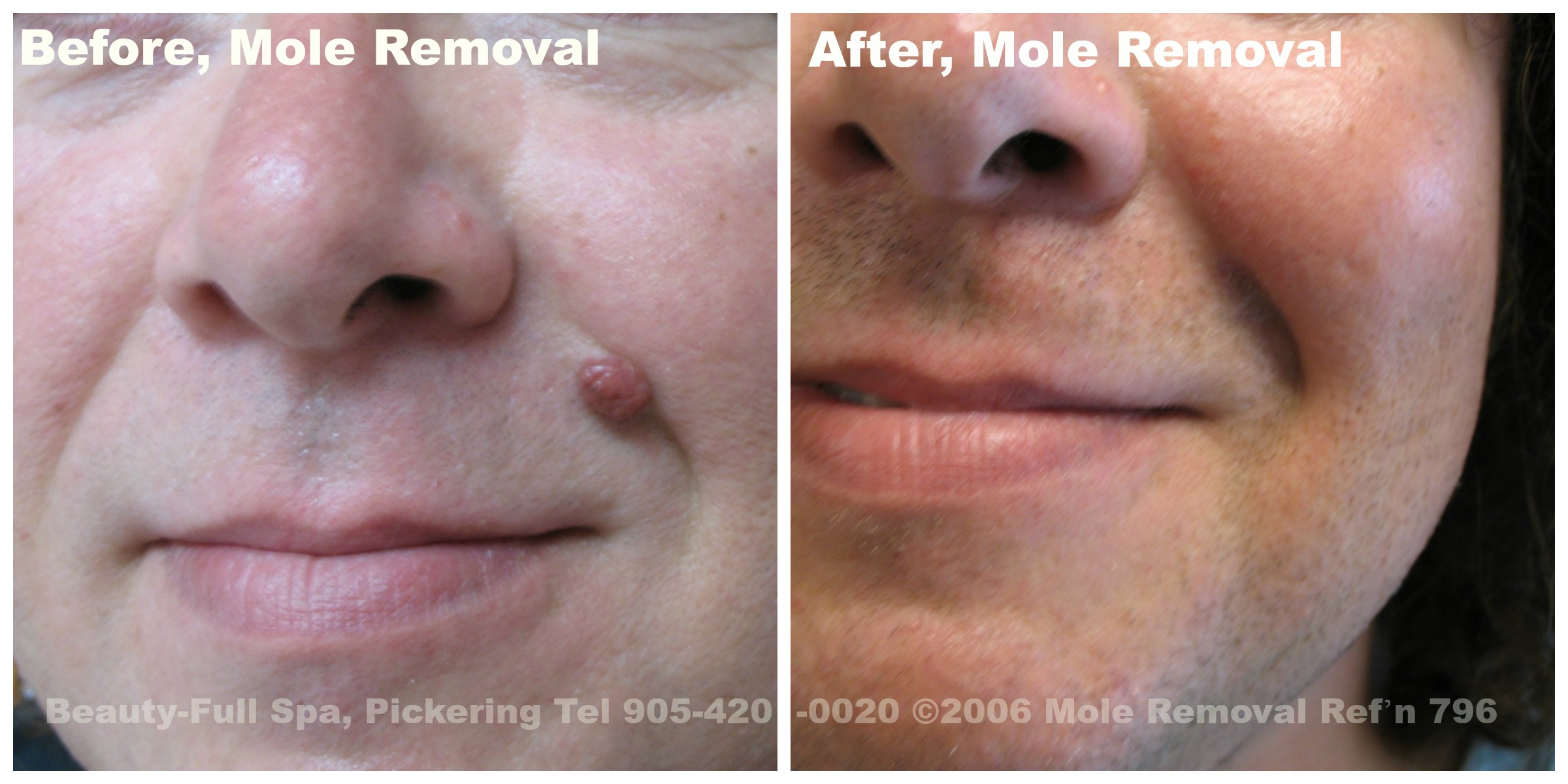 Mole Removal Before & After.